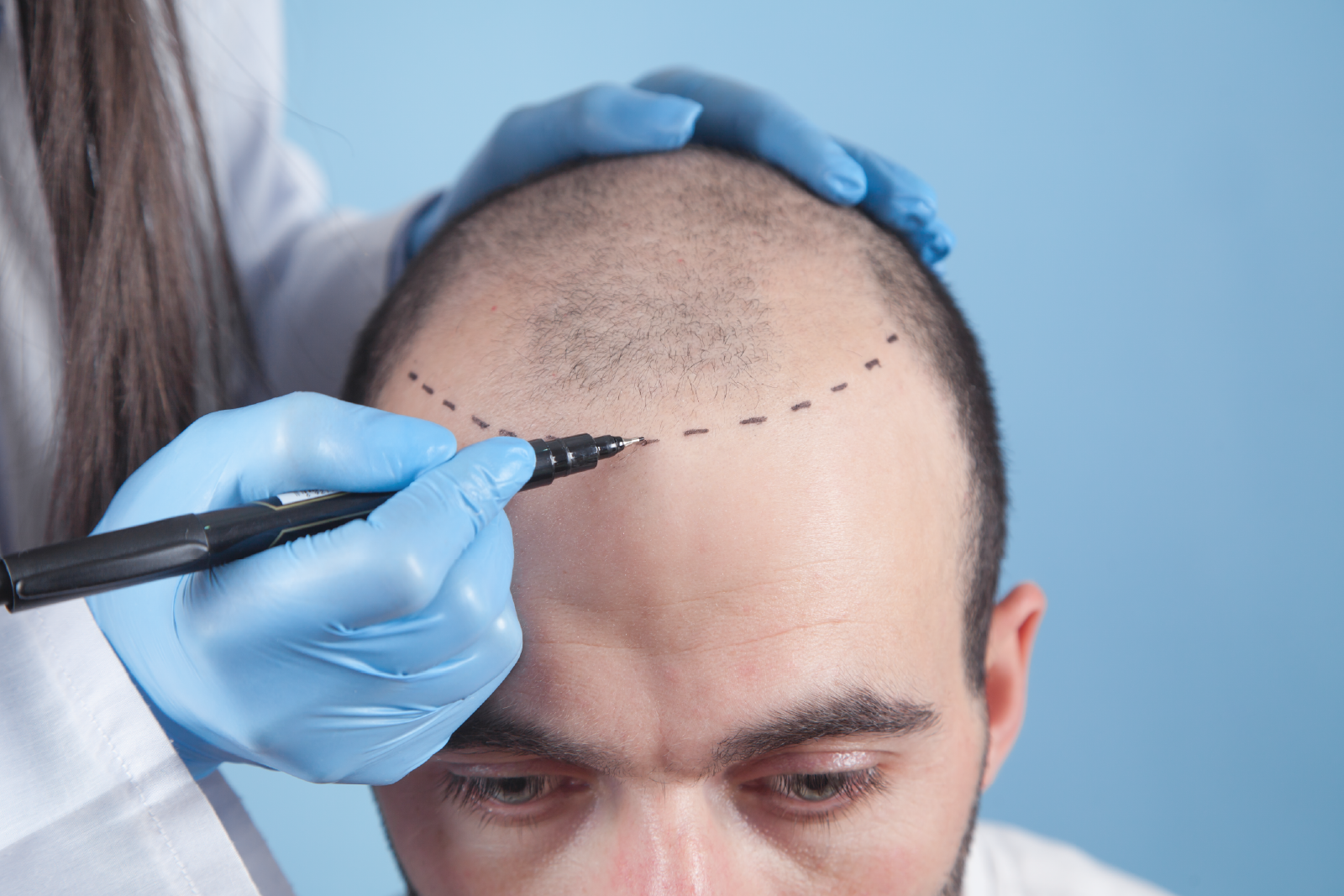 Hair Transplant